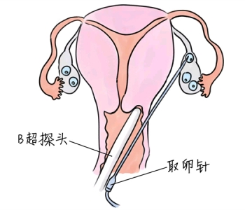 小儿退烧推拿手法 5种珠海捐卵宝宝退烧按摩方法